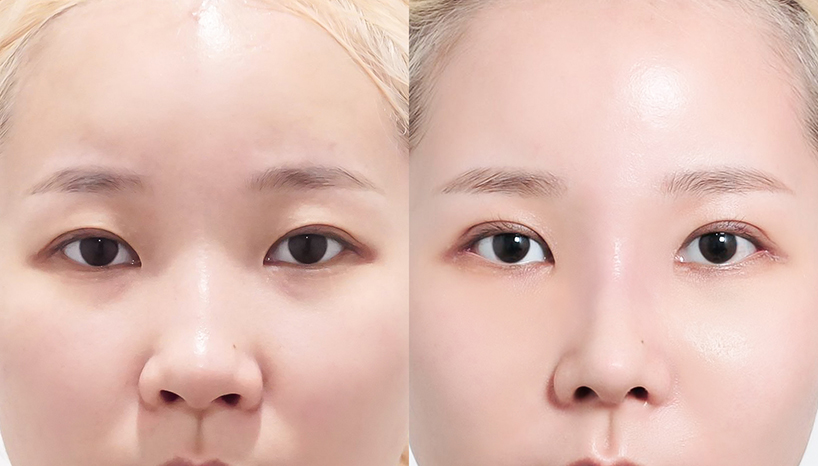 전후사진