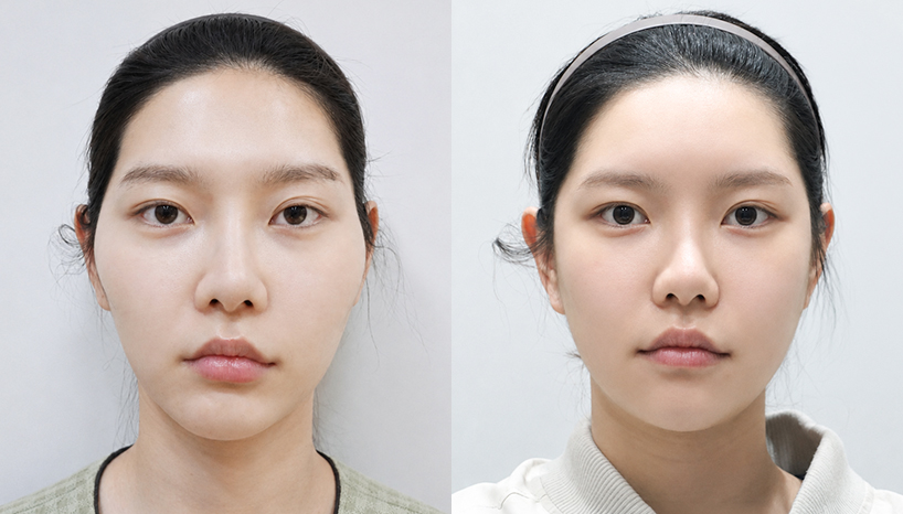 전후사진
