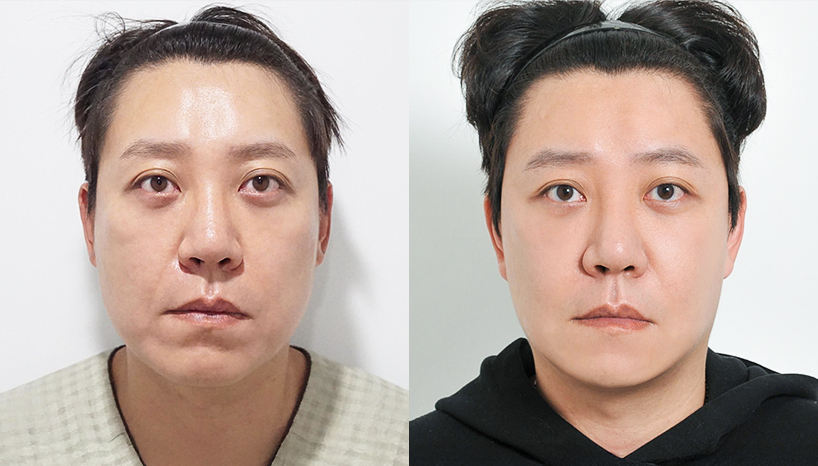 전후사진